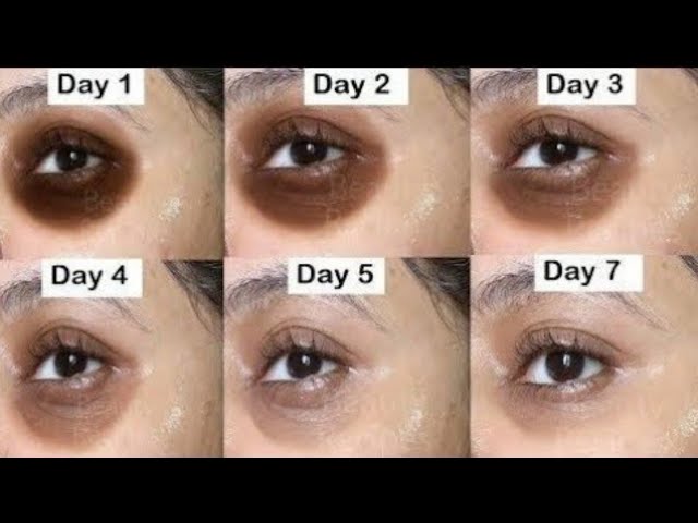 Can ice remove dark circles ?